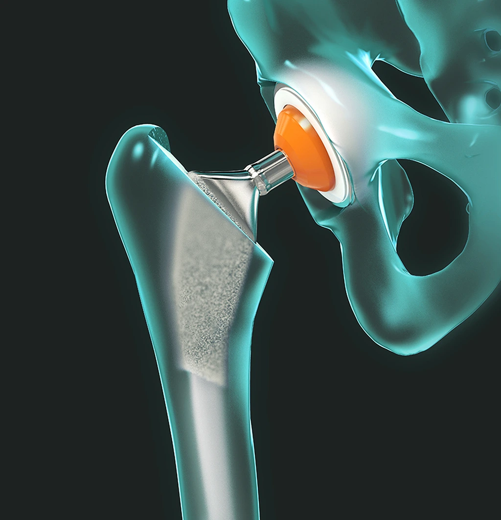 Hip replacement illustration